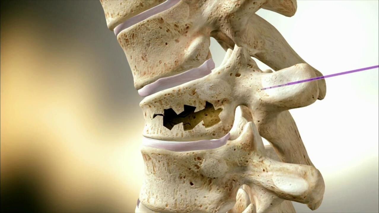 Damaged spinal disc