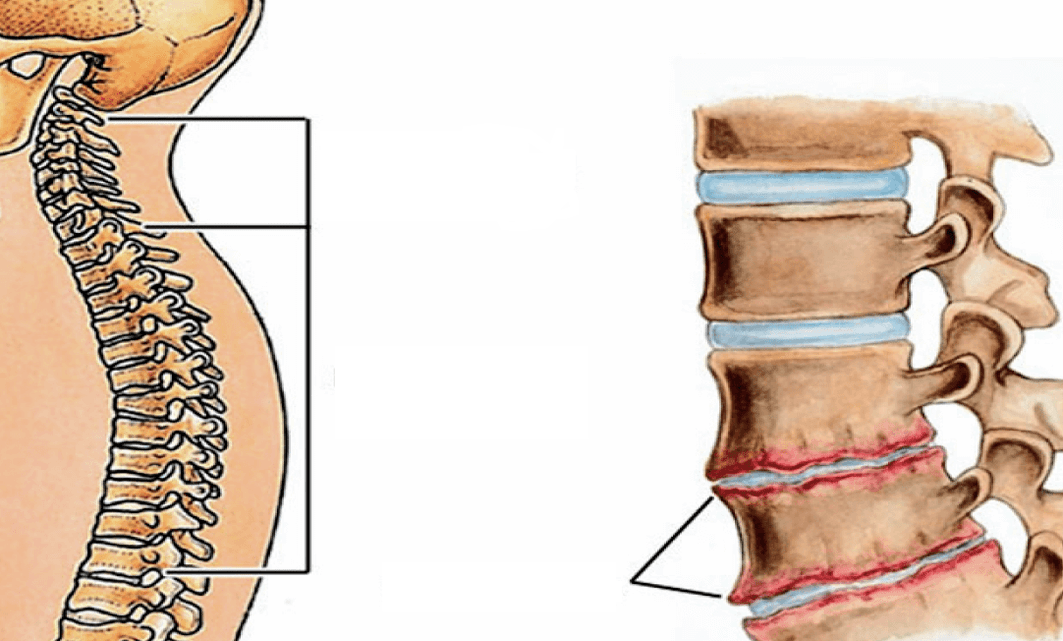 What is the spinal osteochondrosis looks like