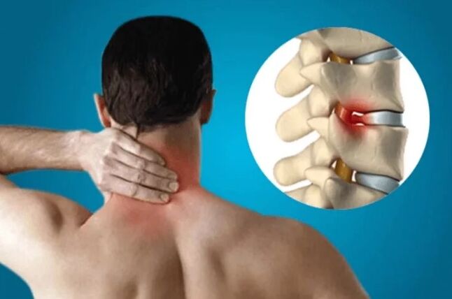 Spinal osteochondrosis