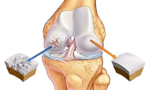 Cartilage and healthy cartilage affected by arthrosis
