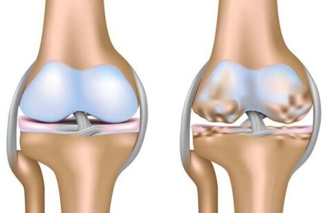 healthy joints and the destruction of knee joints due to arthrosis